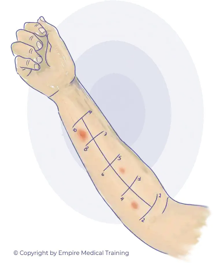 Ilustración de pruebas de alergia en el brazo derecho 