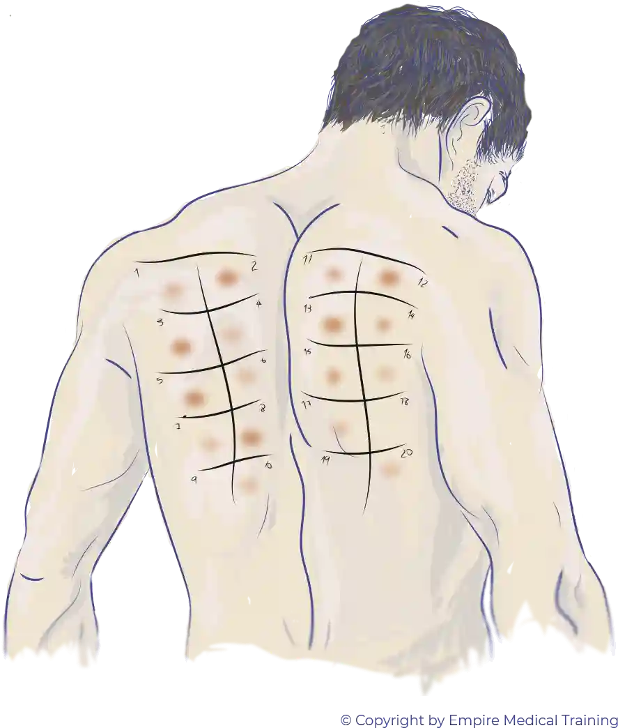 Ilustración de alergia en la espalda
