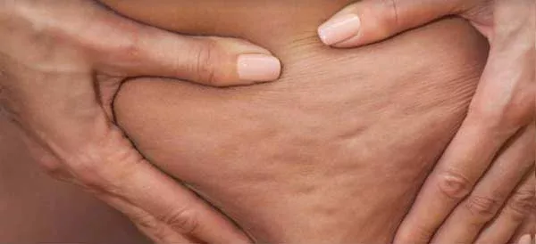 Dile adios a la celulitis