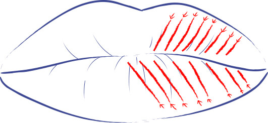 Ilustración de la técnica de carpa labial