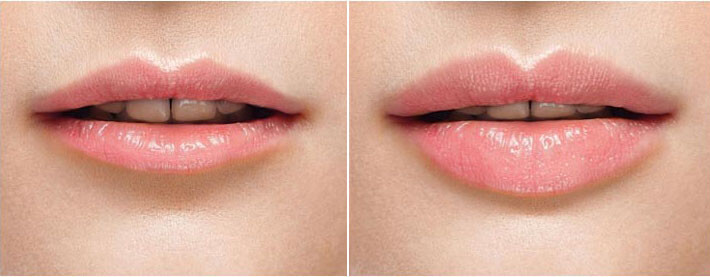 Banner del curso de relleno de labios