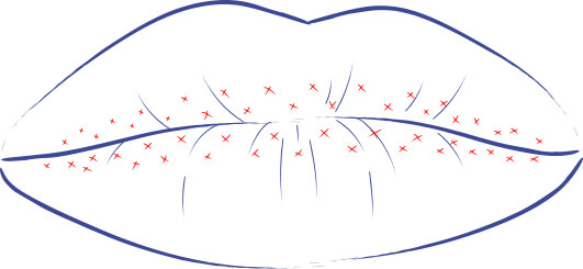 Ilustración de la técnica de Micro gotas