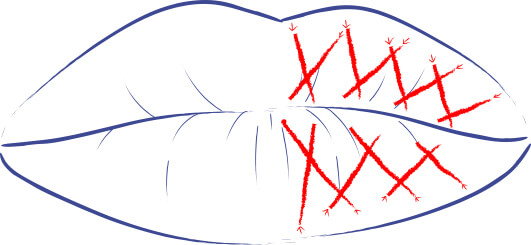 Ilustración de la técnica de rayado cruzado