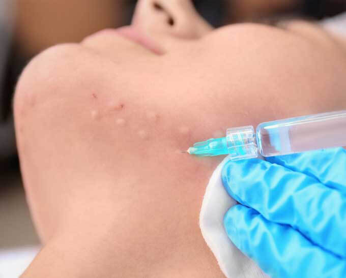 Entrenamiento de mesoterapia para incluir todas las áreas del cuerpo