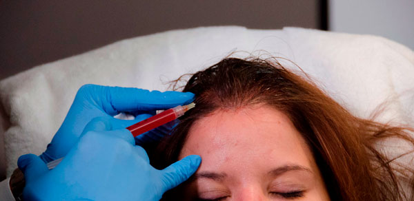 Banner del curso de PRP para el tratamiento de la alopecia