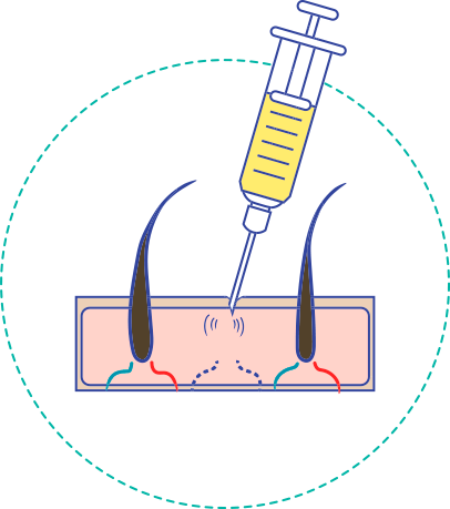 Ilustracion de la primera etapa del tratamiento