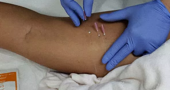 Partes del cuerpo donde se aplican hilos